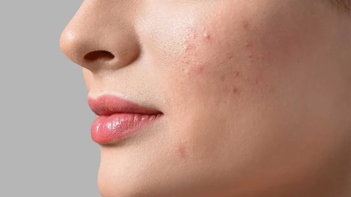 A bottle of Dendriclear serum on a bathroom counter, promoting clear skin and acne treatment.