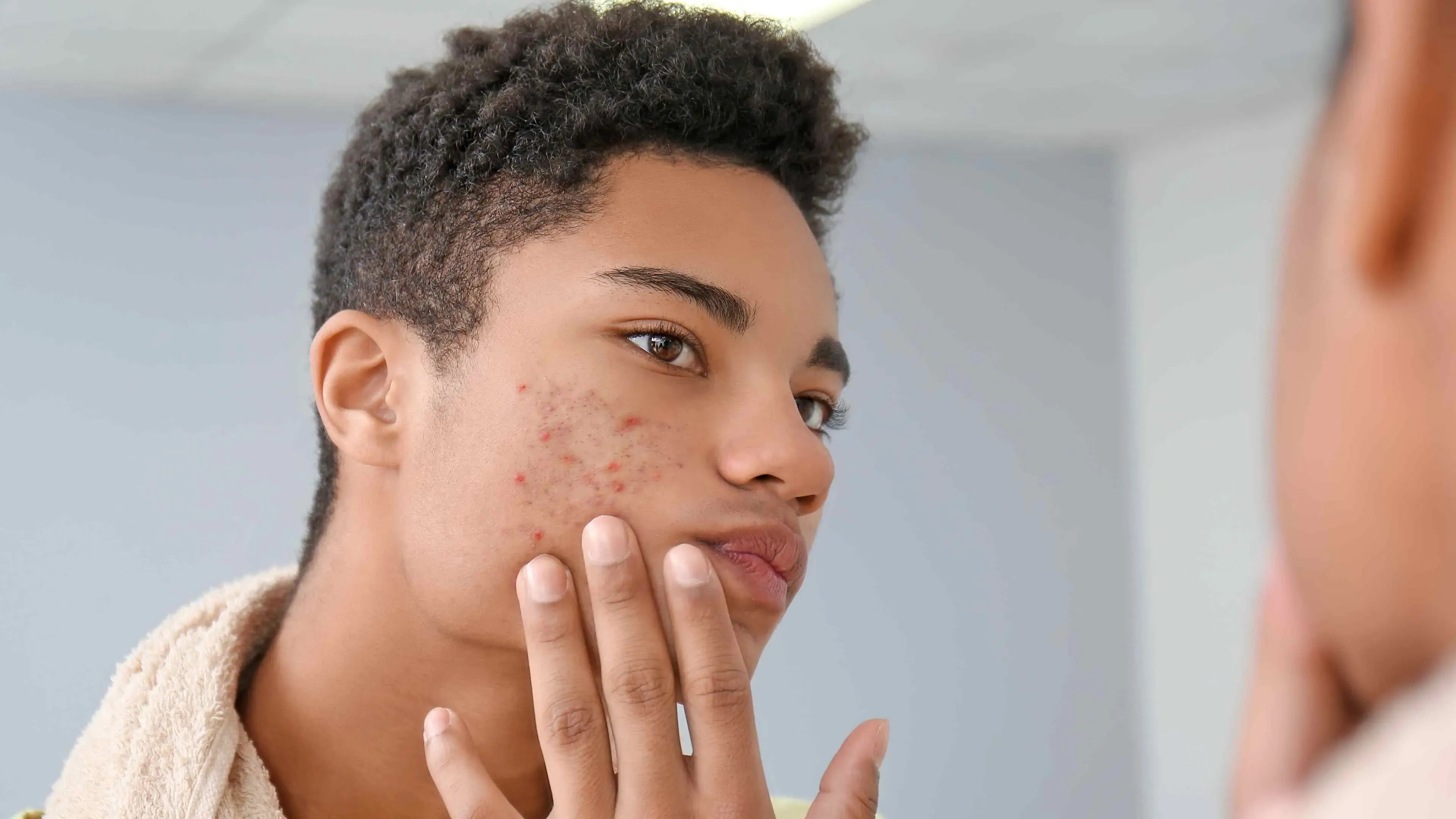 Close-up of skin showing acne scars and hyperpigmentation, highlighting the differences in texture and color.