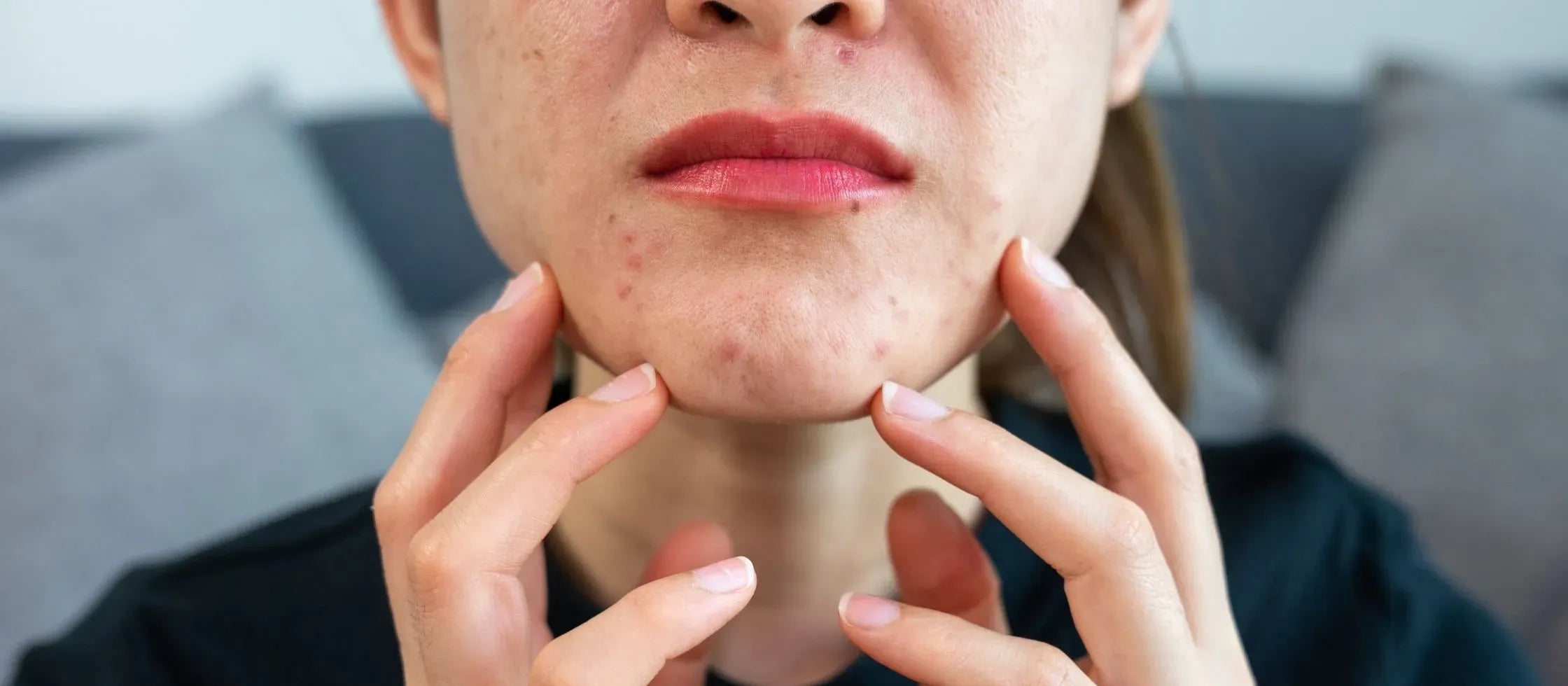 A woman applying anti-acne serum to her face, showcasing its benefits for clear skin.