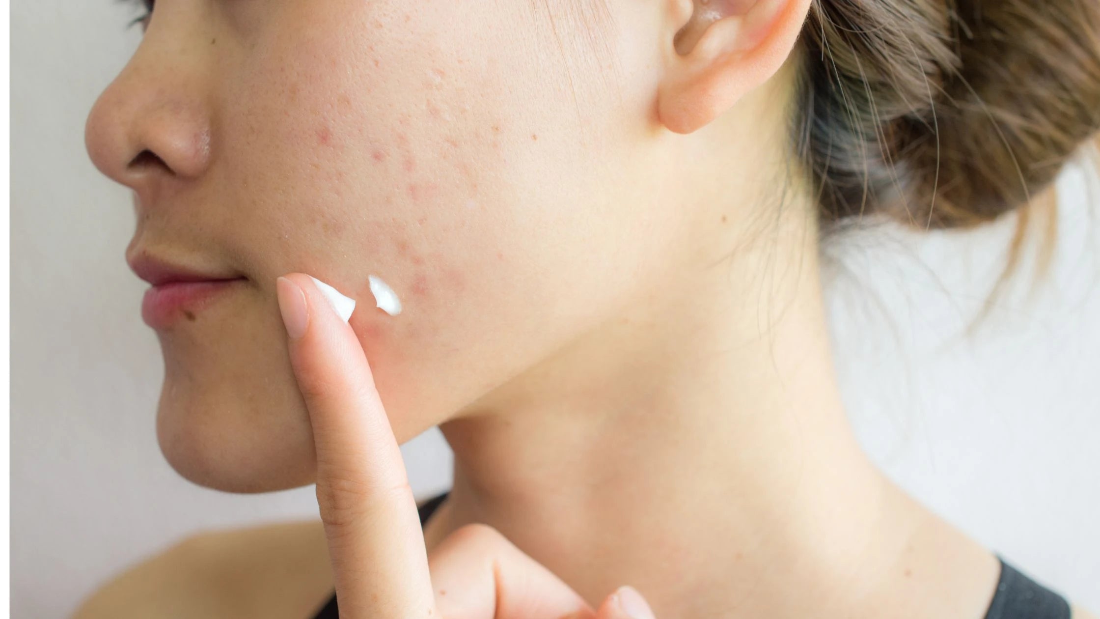 Acne pigmentation treatment guide showing before and after clear skin transformation results