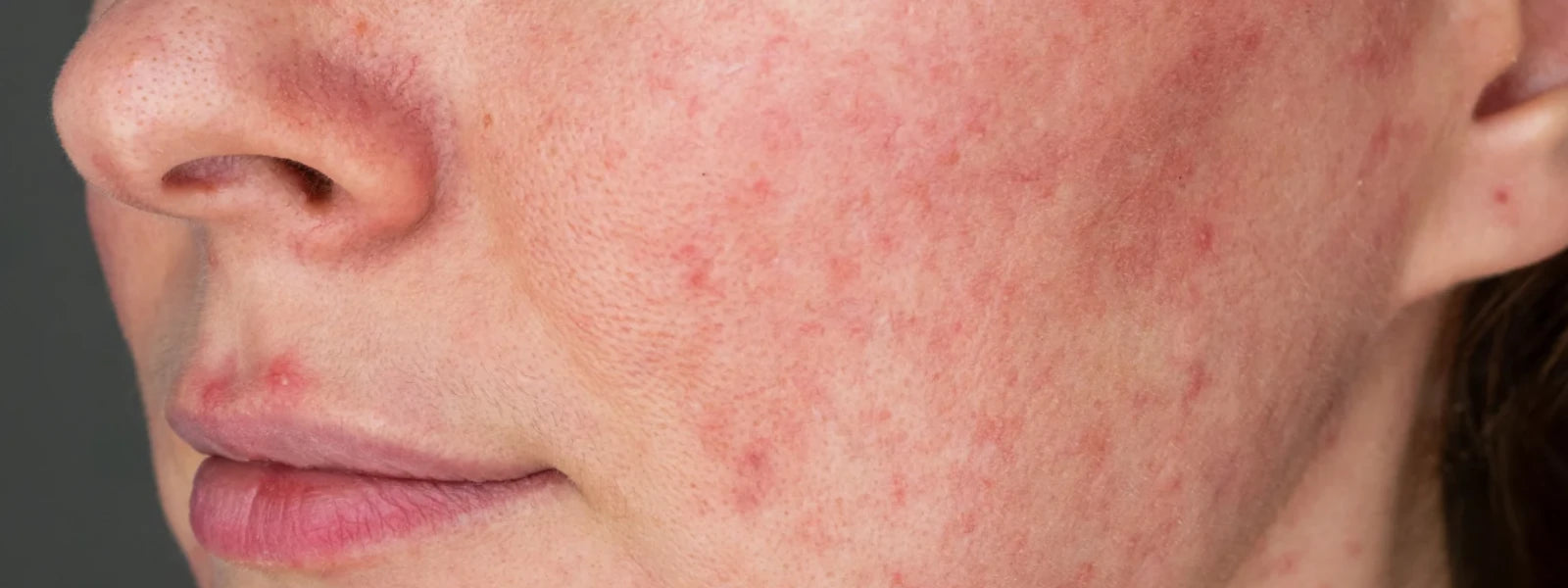 Uncovering the Causes of Facial Pigmentation and How to Treat It