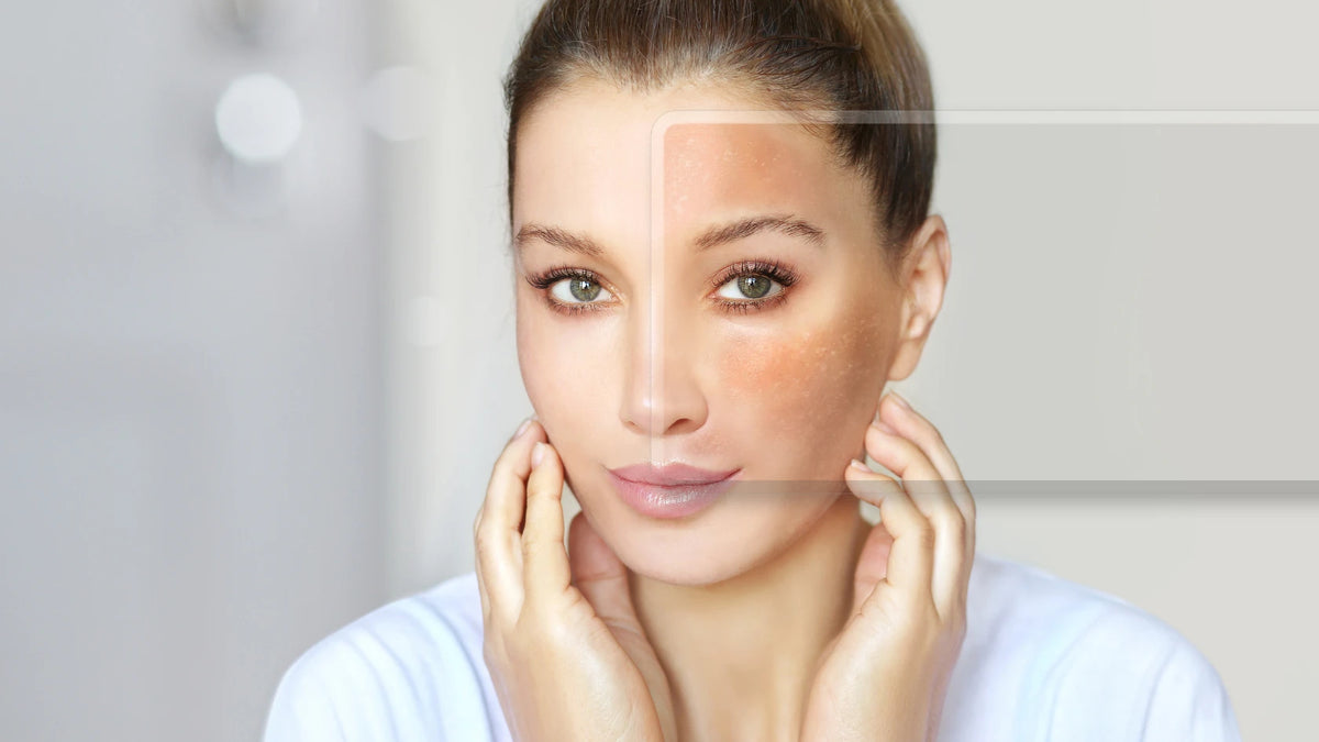 A step-by-step guide to hyperpigmentation treatment without harsh chemicals, showing natural ingredients. 