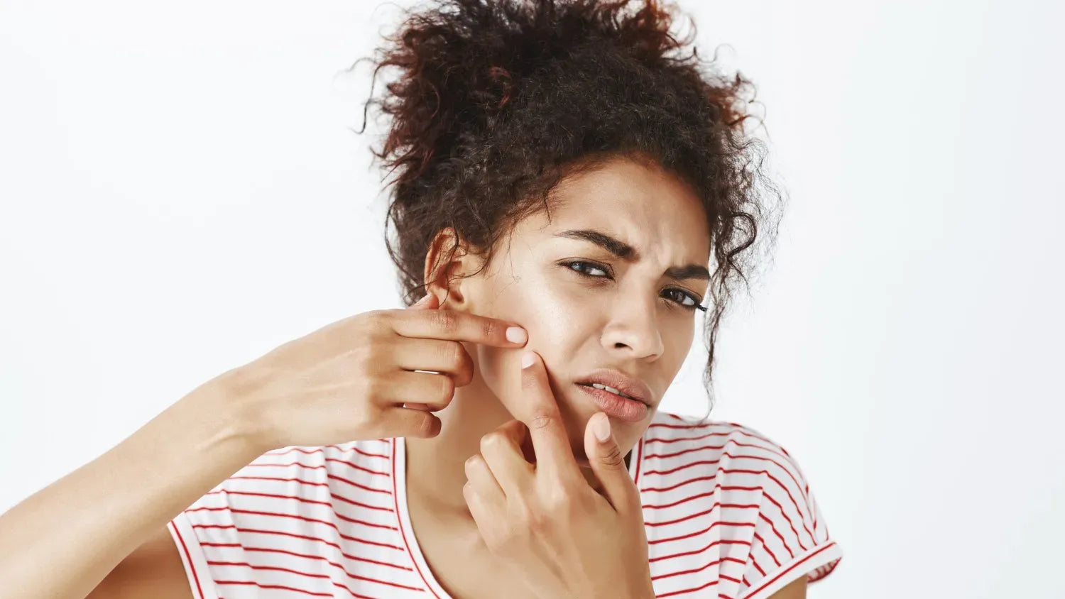 Stunning Irregular Periods Acne Causes image