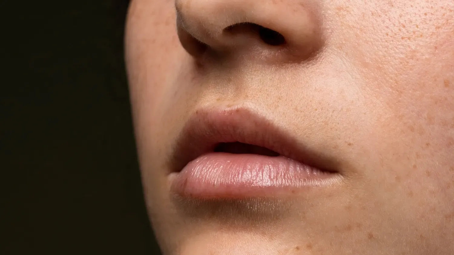 Close-up of a woman's mouth showing hyperpigmentation, highlighting skin discoloration and treatment options.