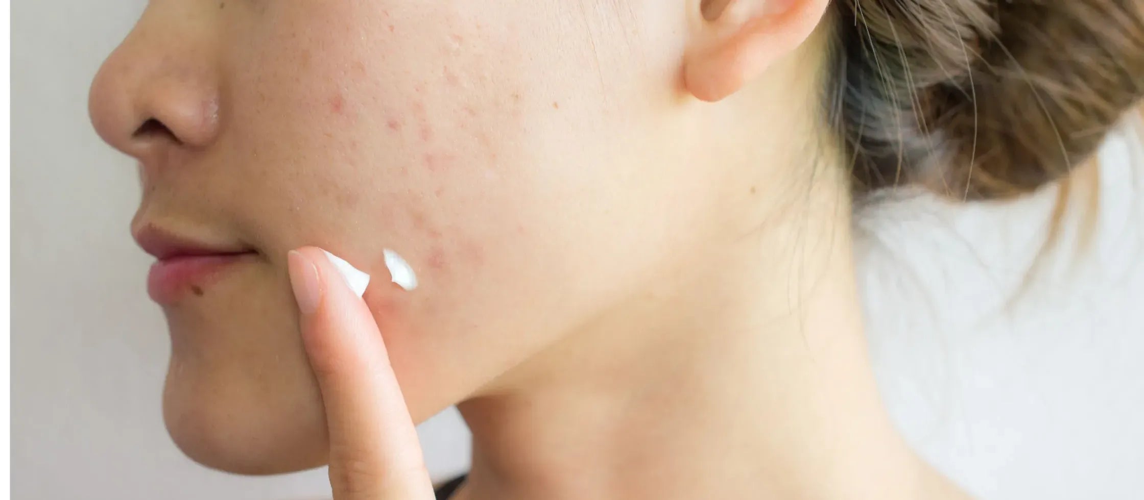 A person applying lightweight sunscreen on oily, acne-prone skin, showcasing essential skincare tips.