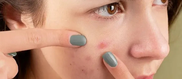 A skincare routine featuring products for removing pimples and dark spots effectively.