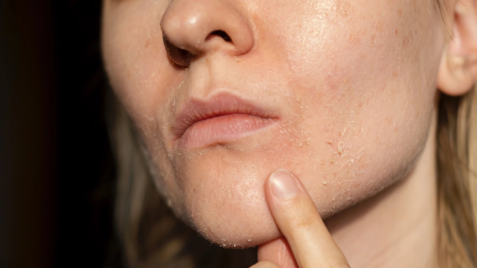 closeup_dry_skin_1783774300.webp 