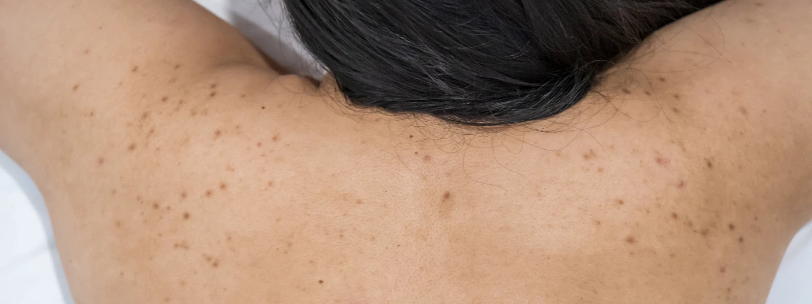 CausesofBodySpots.webp 