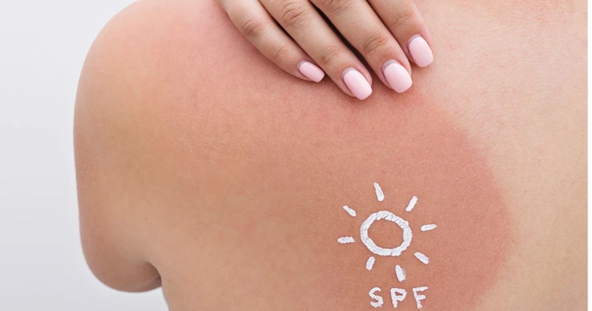The Ultimate Checklist for Preventing Sunburn on Your Body 