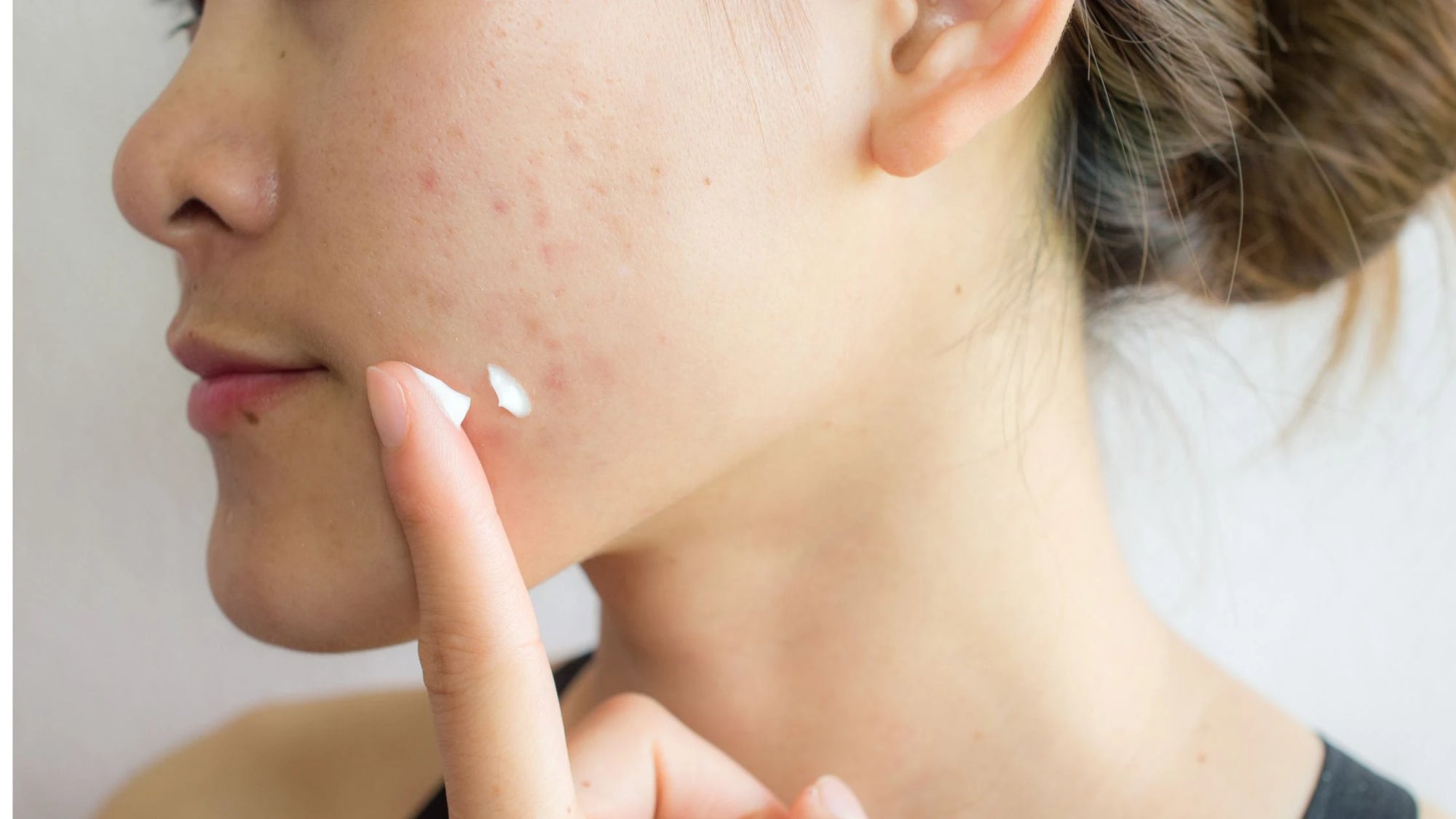 Close-up of radiant skin highlighting the benefits of acne scar serum. 