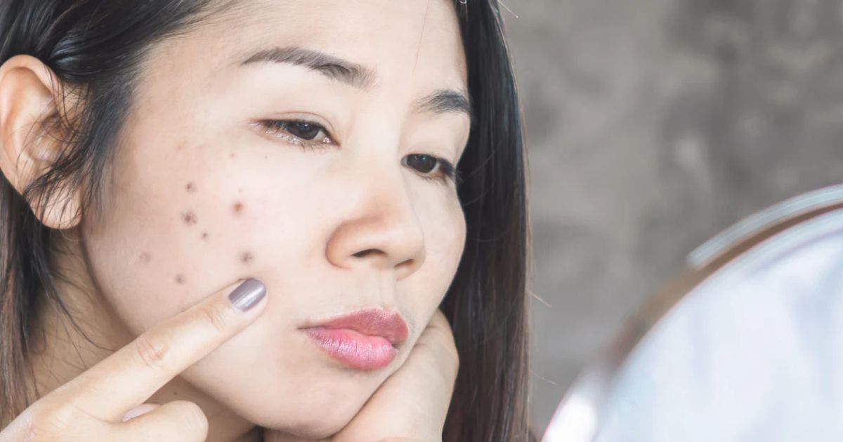 9 Ways to Treat Post-Acne Marks and Hyperpigmentation 