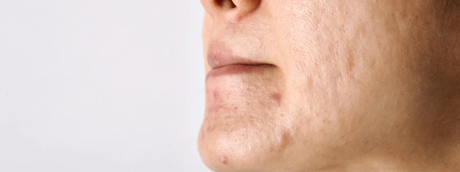 Close-up of skin showing dark spots caused by acne, with text overlay explaining post-inflammatory hyperpigmentation. 