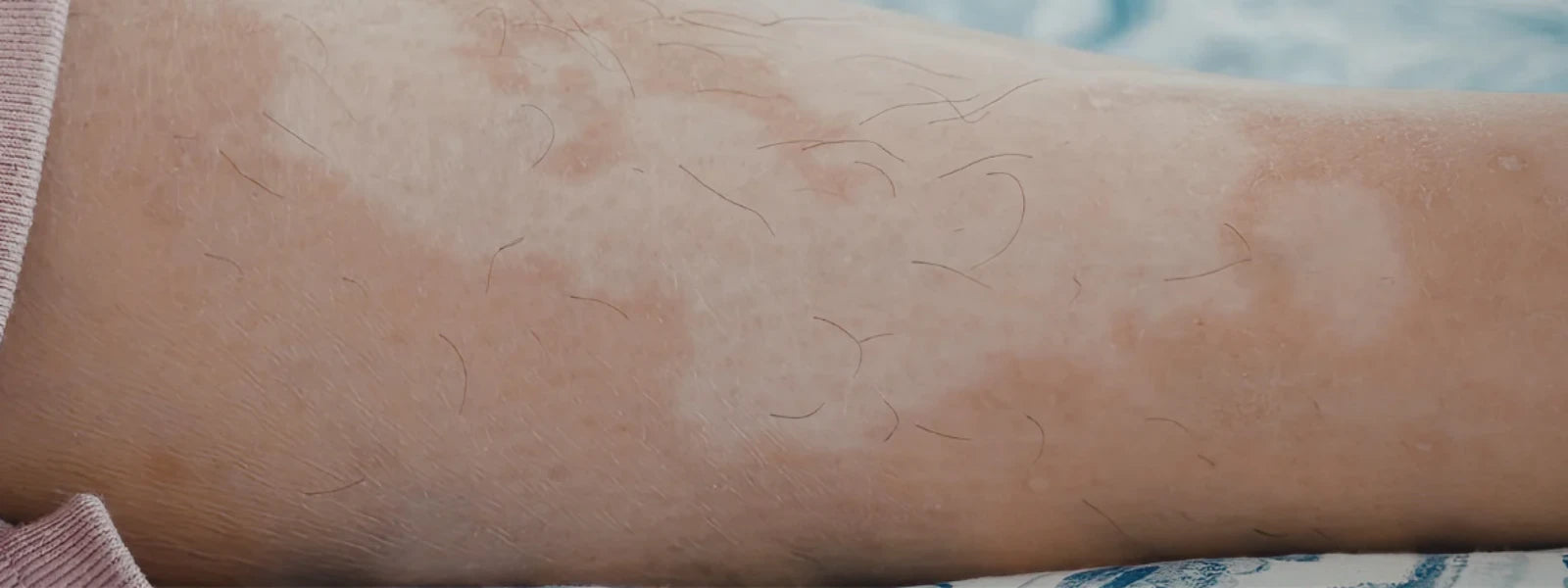 How to Understand Skin Discoloration Causes Effectively – World of Asaya