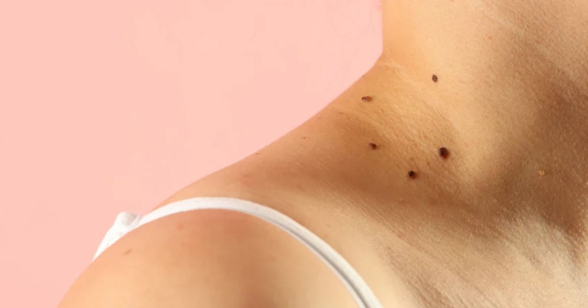 Best Skin Darkening Treatment on Neck FAQ: Causes & Remedies 