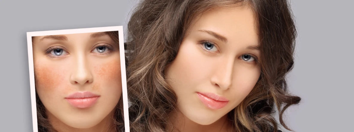 _Sun and Hyperpigmentation.webp 