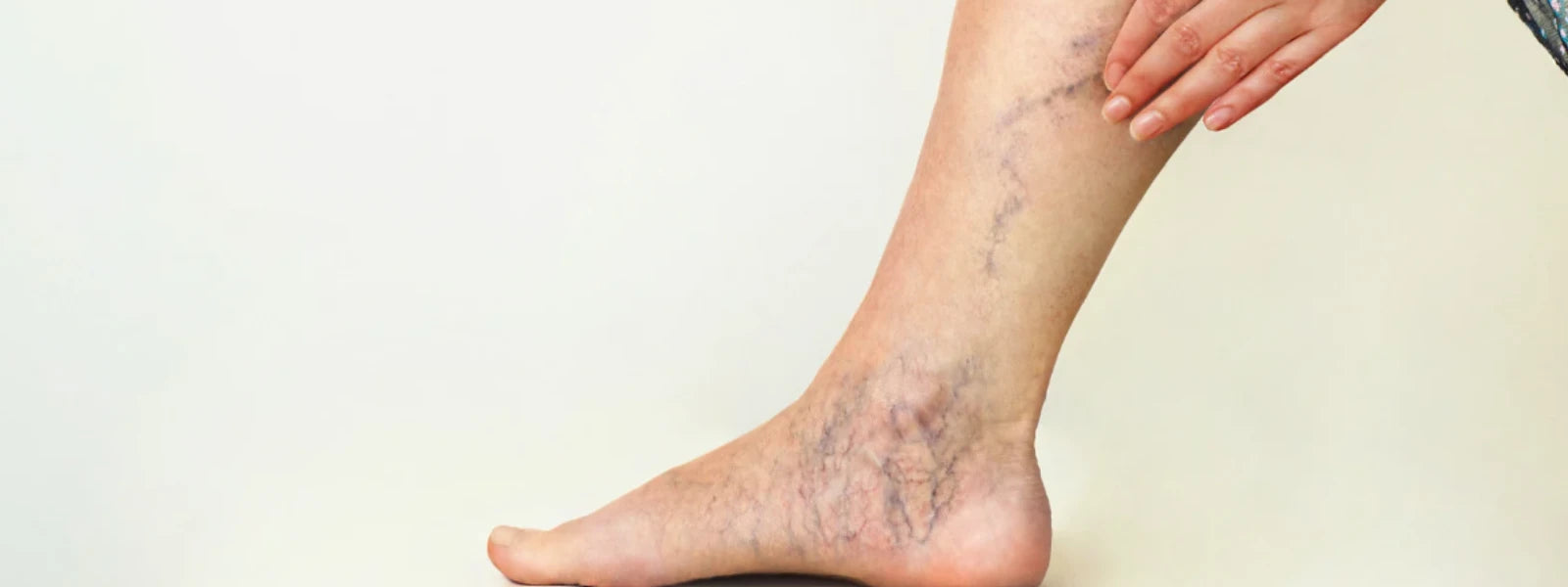 A Step-by-Step Guide to Treating Pigmentation on Legs 