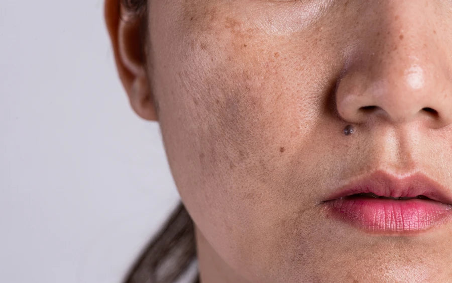 Skincare guide for treating stubborn pigmentation and dark spots. 
