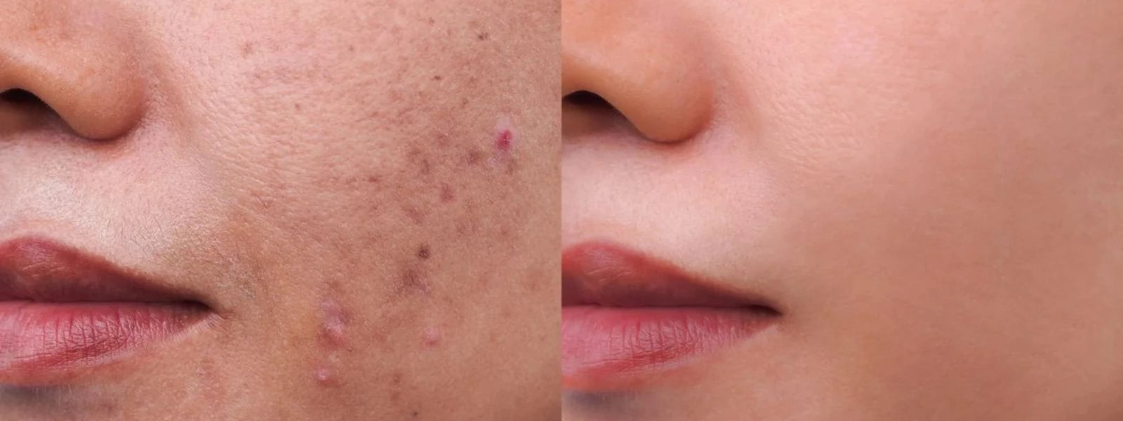 hyperpigmentation.webp 