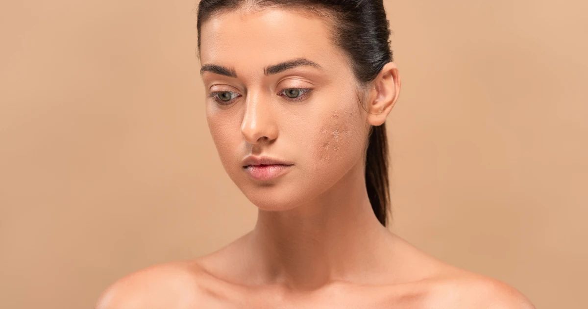 How to Fade Stubborn Acne Marks on Indian Skin Naturally 