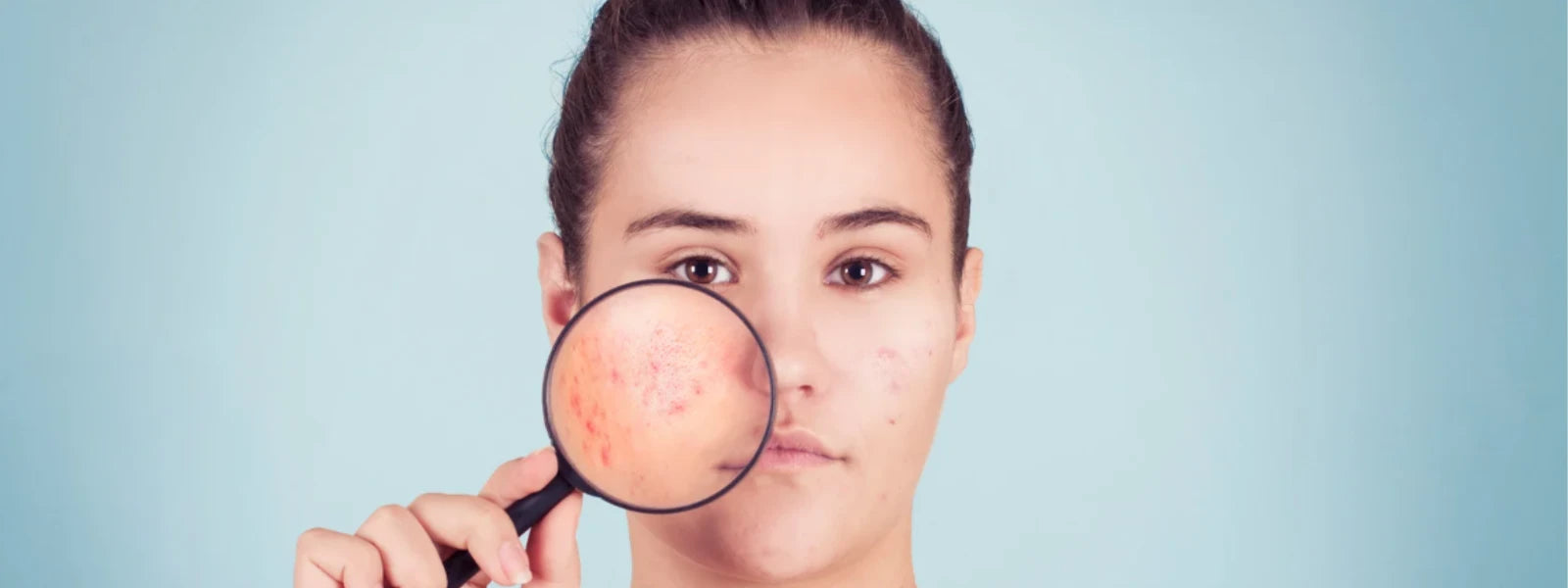 Cystic Acne: Your Complete Skincare Guide 