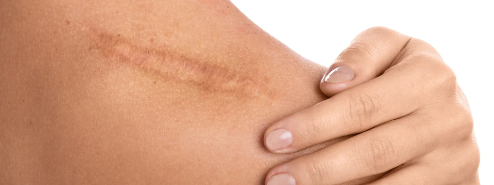 Essential Checklist: Scar Healing Strategies 