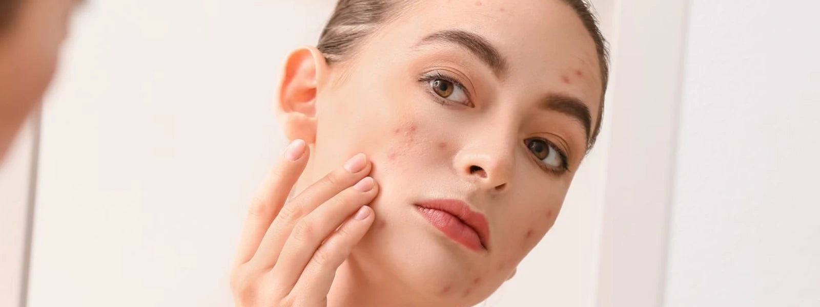 Essential Checklist: Understanding Fungal Acne & Malassezia Folliculitis 