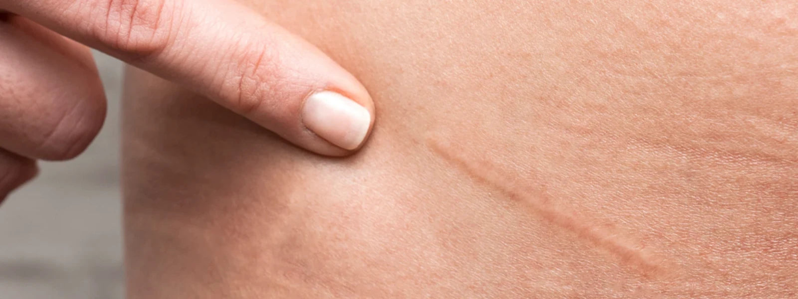 Essential Checklist: Vitamin E for Scar Healing 