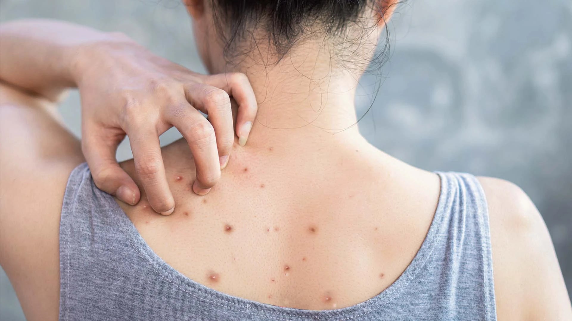 How Body Acne Forms: Understanding Causes and Prevention 