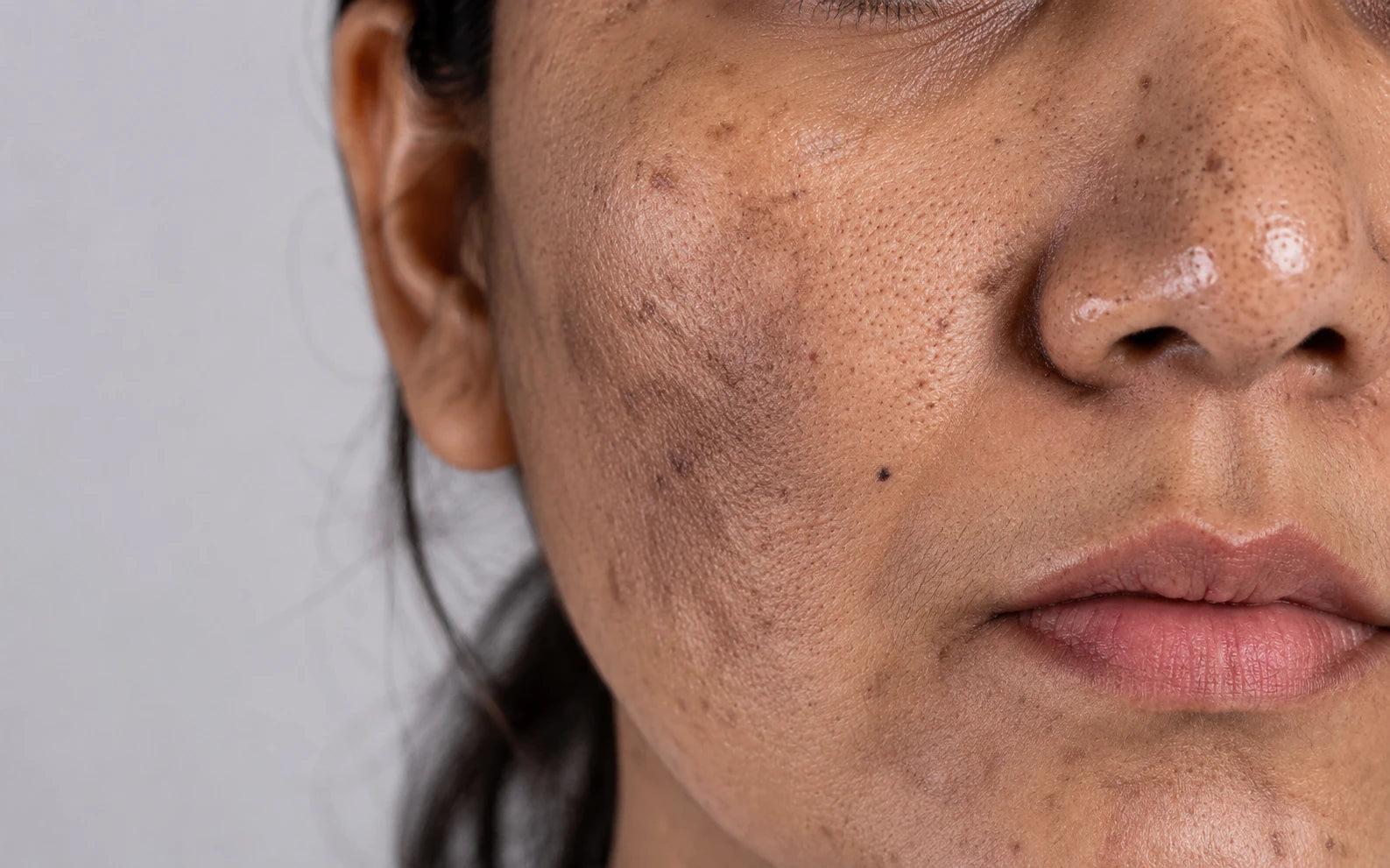 How to Fade Dead Skin Buildup on Face Naturally at Home 