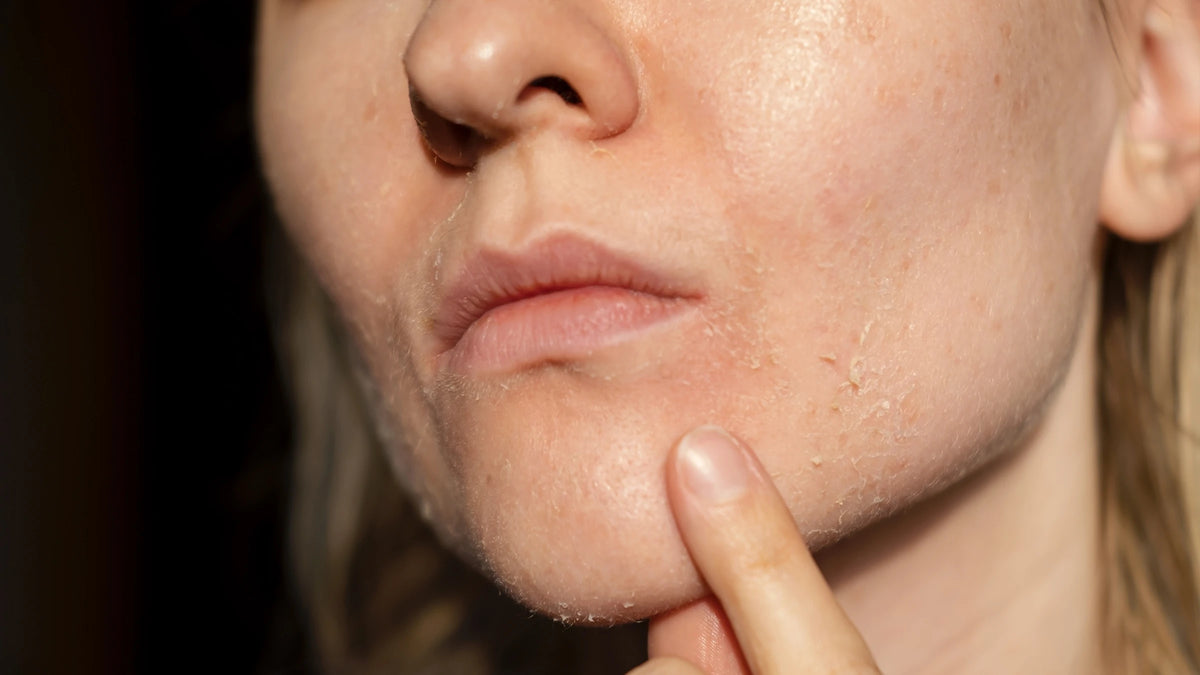 How to Hydrate Oily Skin Without Oil: Your FAQ Answered 