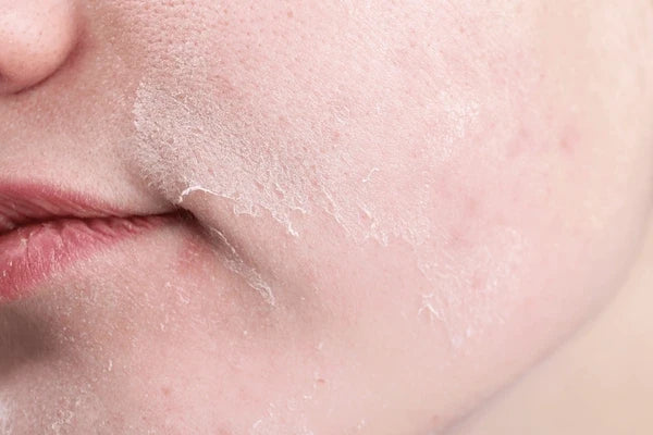 How to Identify Dehydrated Skin Causes Without Dryness 