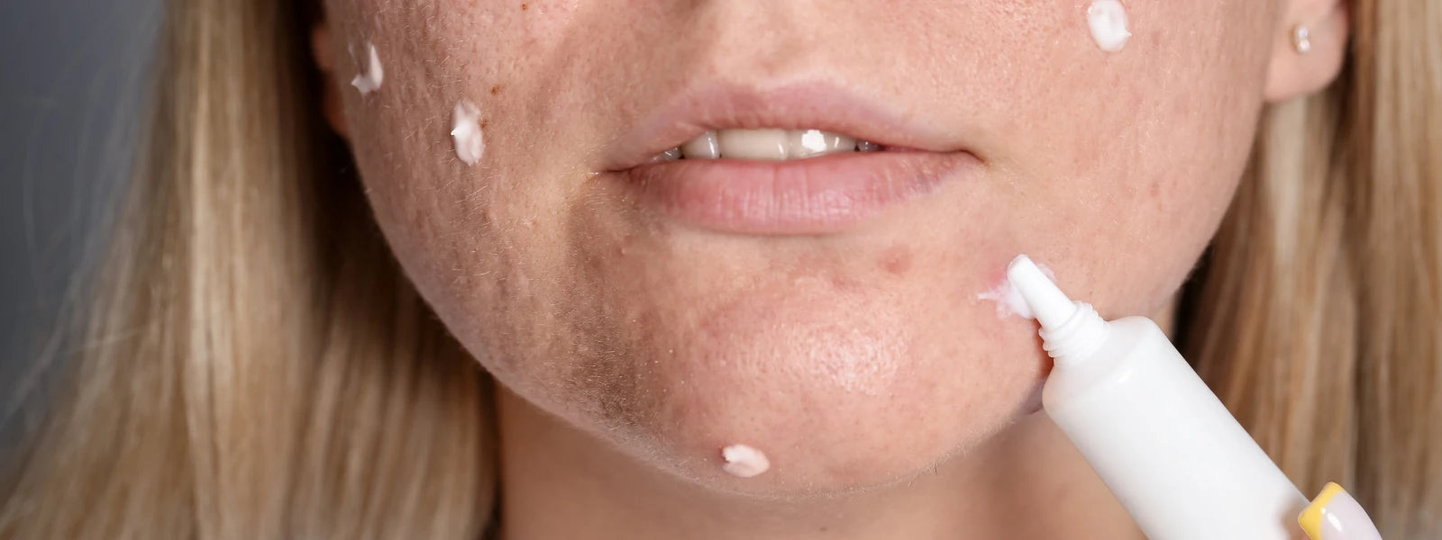 How to Identify What Hyperpigmentation Looks Like 