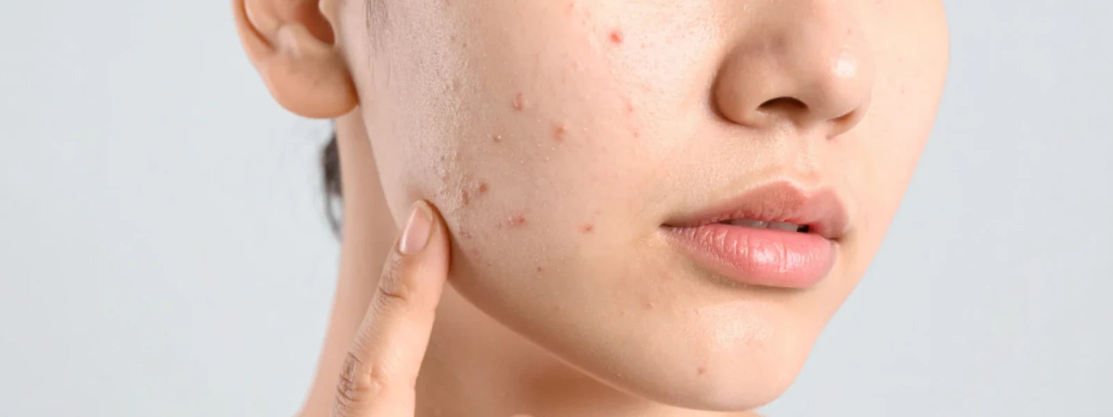 How to Identify Which Skin Type Causes Pimples 