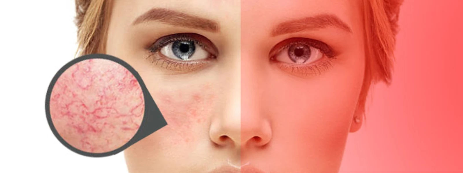 How to Reduce Rosacea Redness: Effective Treatments for Relief 