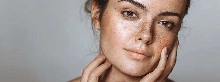 How to Treat Post-Inflammatory Hyperpigmentation on Your Face Effectively 