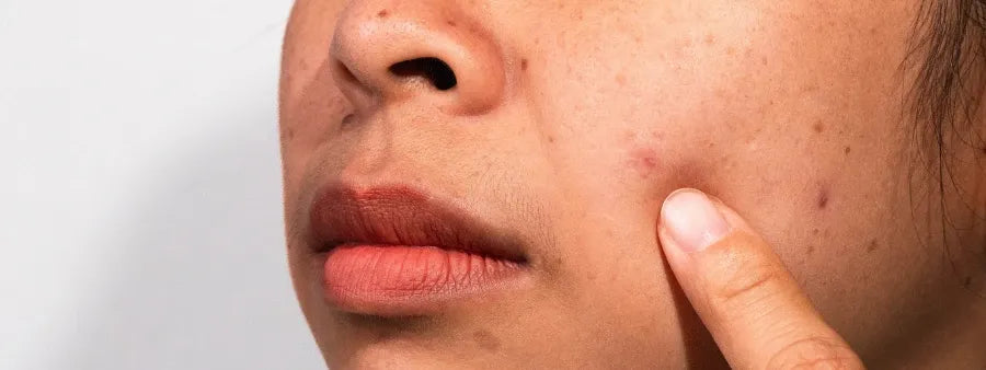 Hyperpigmentation and Indian Skin: Your Complete FAQ 
