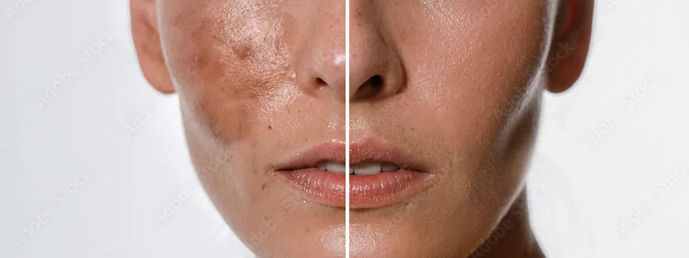 Melasma 101: Everything You Need to Know 