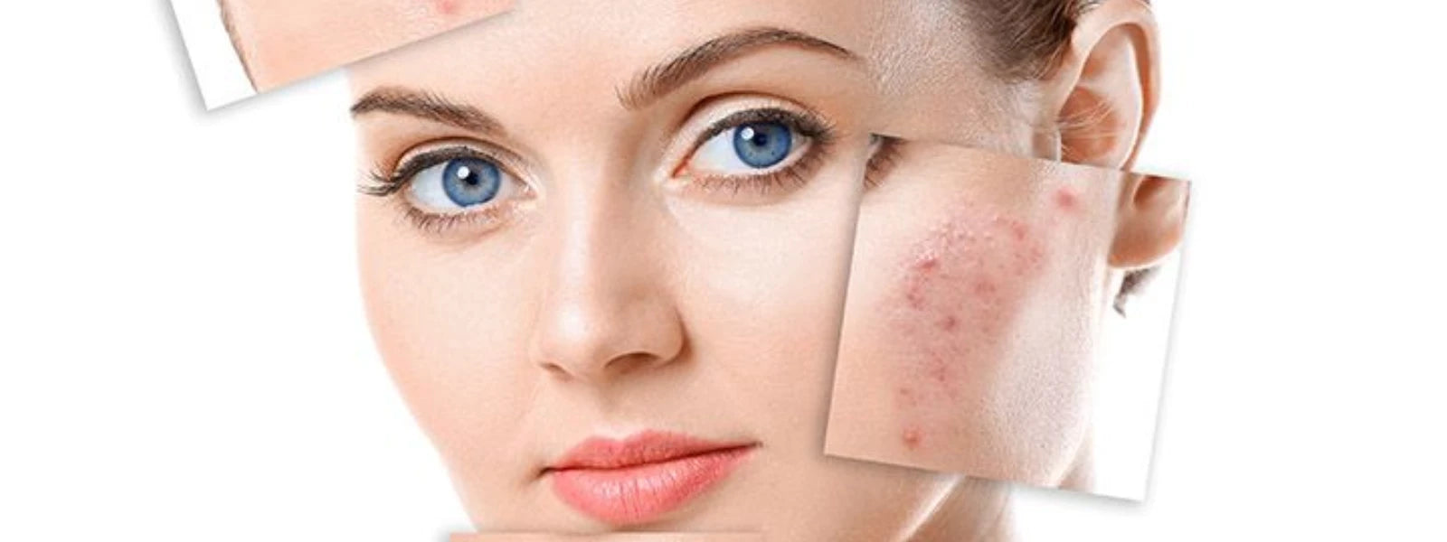 hyperpigmentation(5).webp 