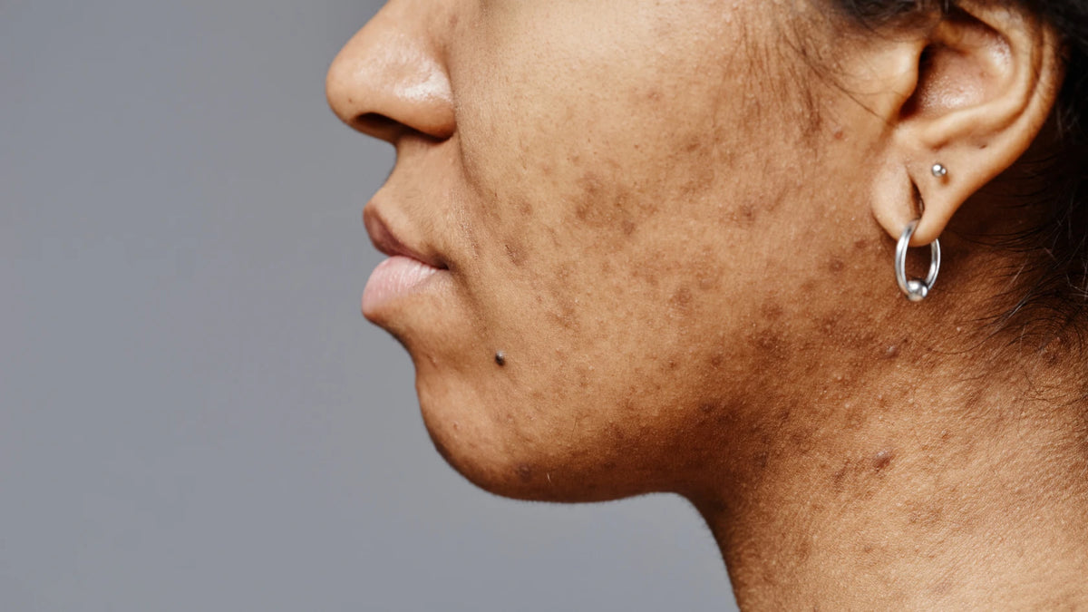 The Right Way to Remove Dark Spots on Melanin-Rich Skin 