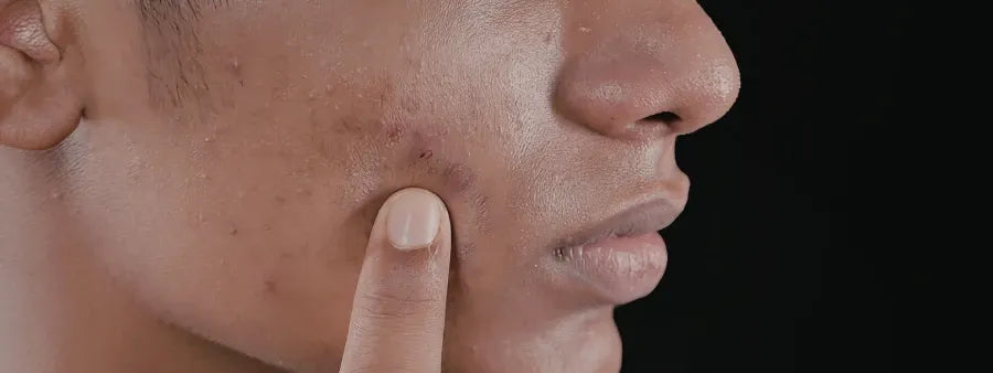 The Ultimate Checklist: Understanding What Causes Skin Discoloration 