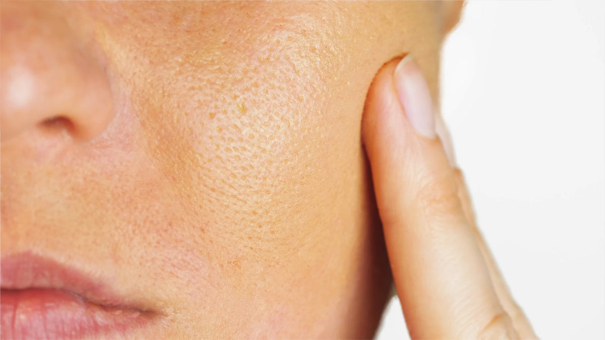 Tranexamic Acid for Pigmentation: Is It Right for Your Melanin-Rich Skin? 