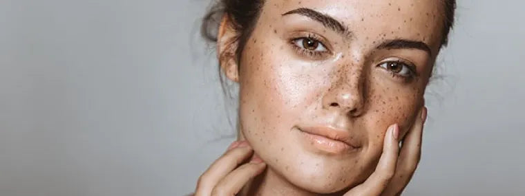 Treating Facial Skin Discoloration: A Complete Guide 