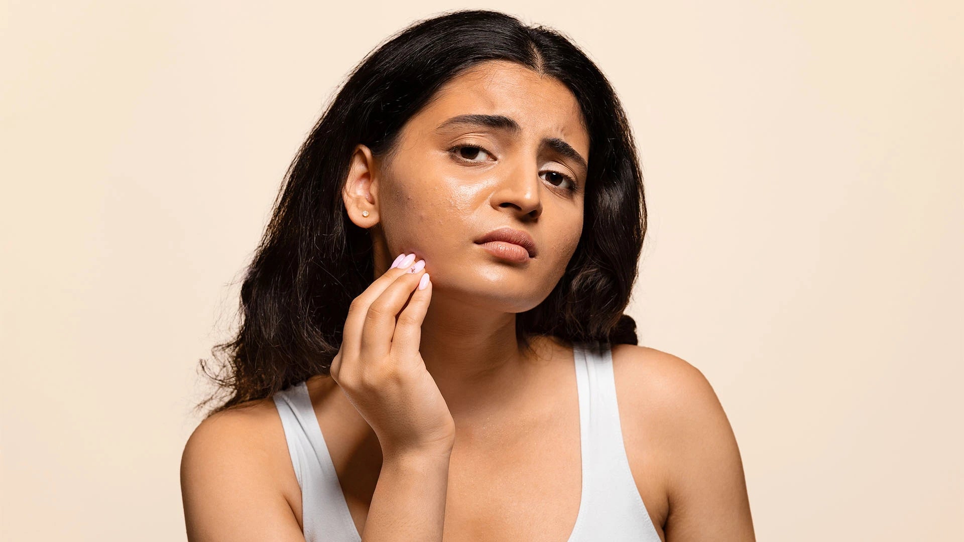 Ultimate Guide: Treating Acne on Oily Skin Step-by-Step 